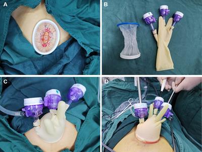 Application of Single-Port Laparoscopic Surgery in Myomectomy